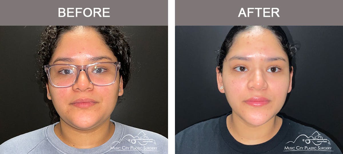 Facial Liposuction Before & After Gallery - Patient 166685 - Image 1