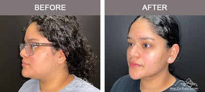 Facial Liposuction Before & After Gallery - Patient 166685 - Image 2