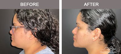 Facial Liposuction Before & After Gallery - Patient 166685 - Image 3