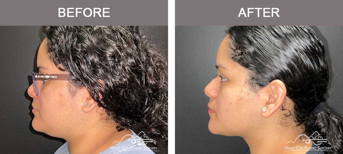 Facial Liposuction Before & After Gallery - Patient 166685 - Image 3
