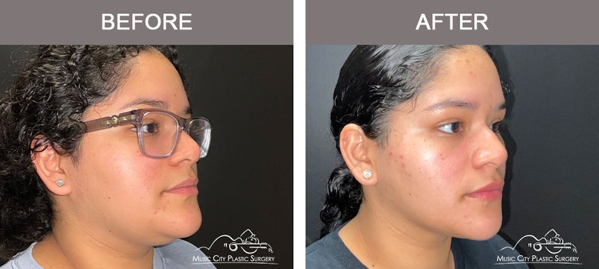 Facial Liposuction Before & After Gallery - Patient 166685 - Image 4