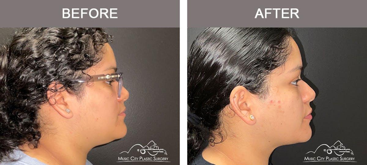 Facial Liposuction Before & After Gallery - Patient 166685 - Image 5