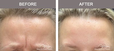 Dysport or Botox Before & After Gallery - Patient 212937 - Image 1