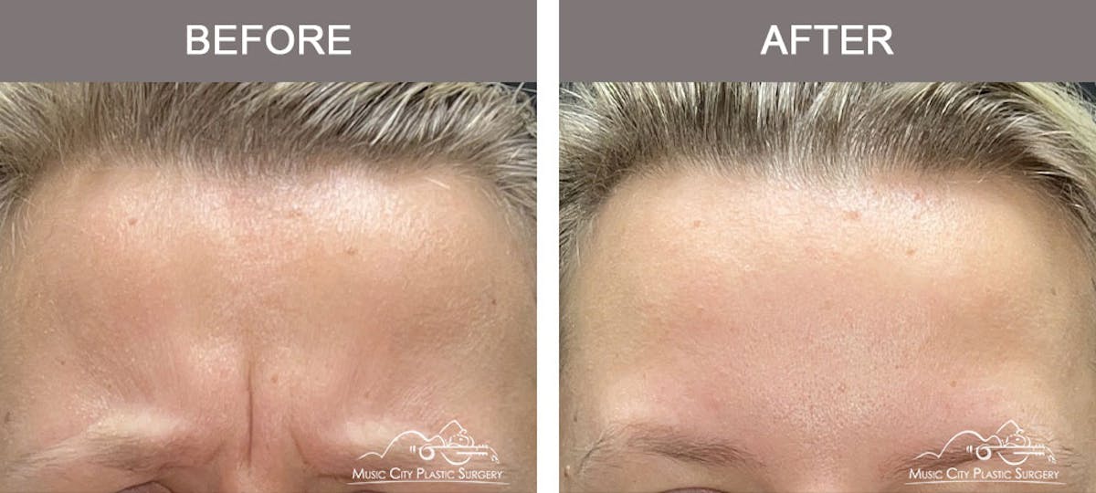 Dysport or Botox Before & After Gallery - Patient 212937 - Image 1