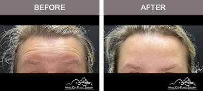 Dysport or Botox Before & After Gallery - Patient 212937 - Image 2