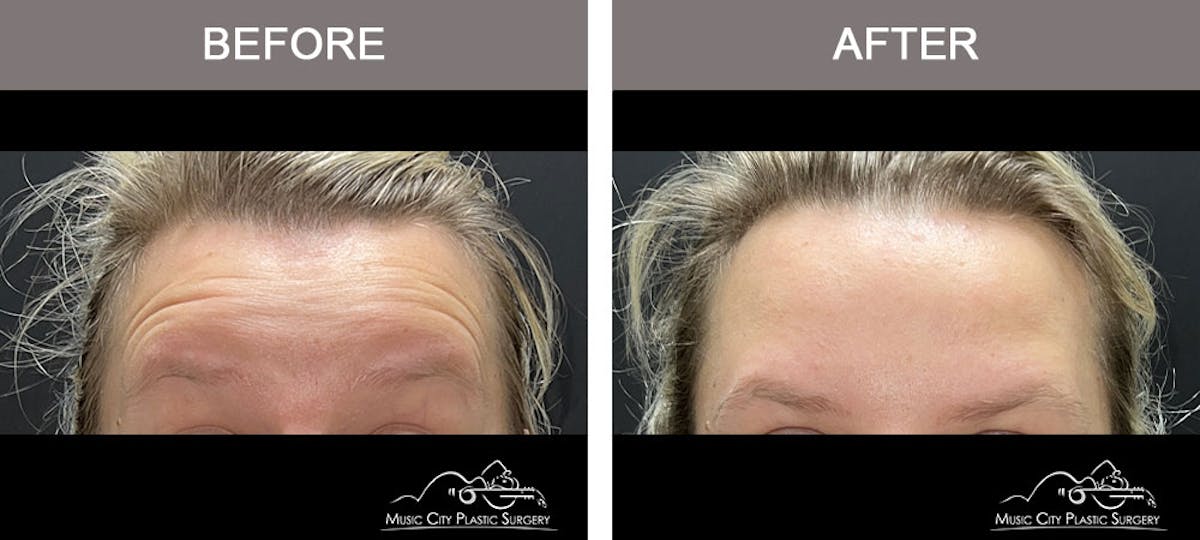Dysport or Botox Before & After Gallery - Patient 212937 - Image 2