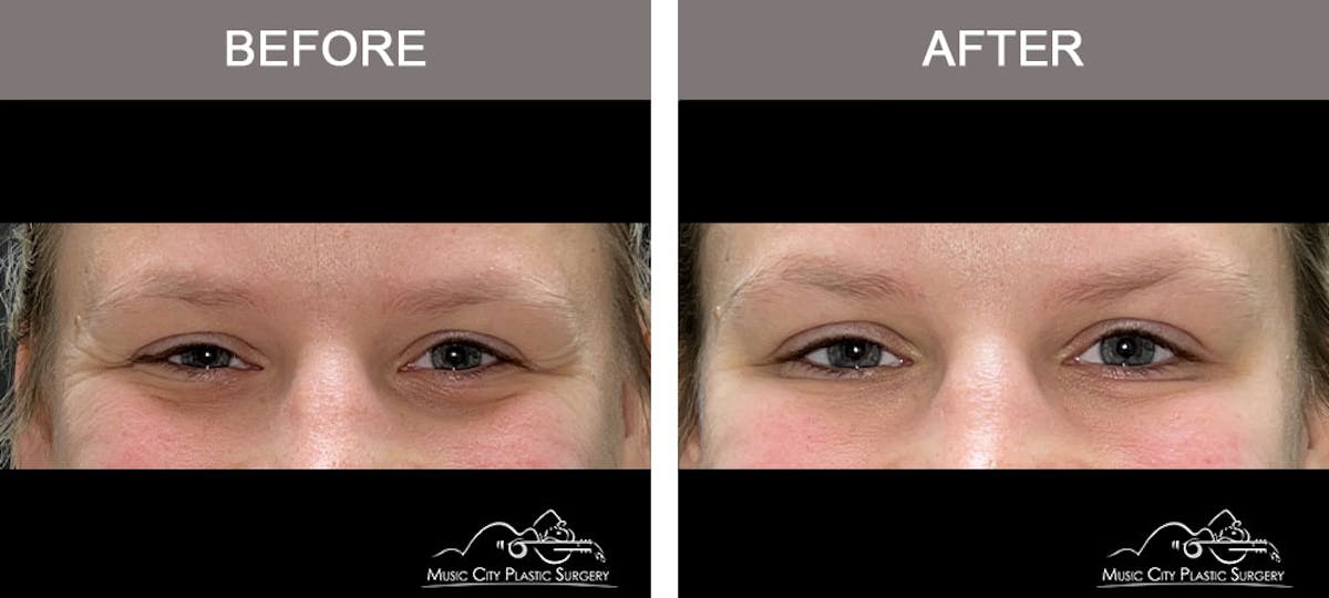Dysport or Botox Before & After Gallery - Patient 212937 - Image 3
