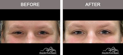 Dysport or Botox Before & After Gallery - Patient 212937 - Image 3