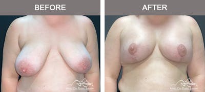 Breast Lift Before & After Gallery - Patient 285547 - Image 1