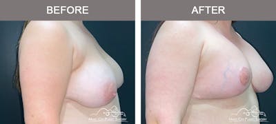 Breast Lift Before & After Gallery - Patient 285547 - Image 2