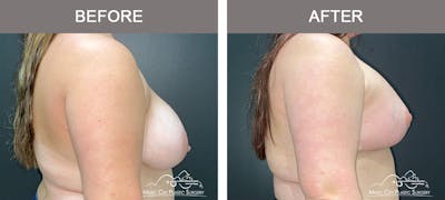 Breast Lift Before & After Gallery - Patient 285547 - Image 3