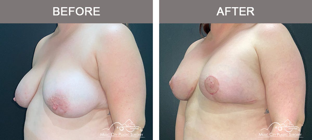 Breast Lift Before & After Gallery - Patient 285547 - Image 4