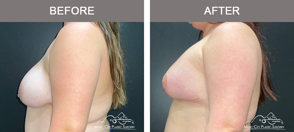 Breast Lift Before & After Gallery - Patient 285547 - Image 5
