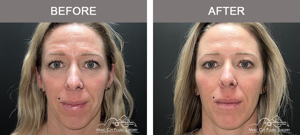 Dermal Fillers Before & After Gallery - Patient 179930 - Image 1