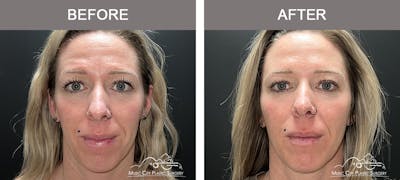 Dermal Fillers Before & After Gallery - Patient 179930 - Image 1