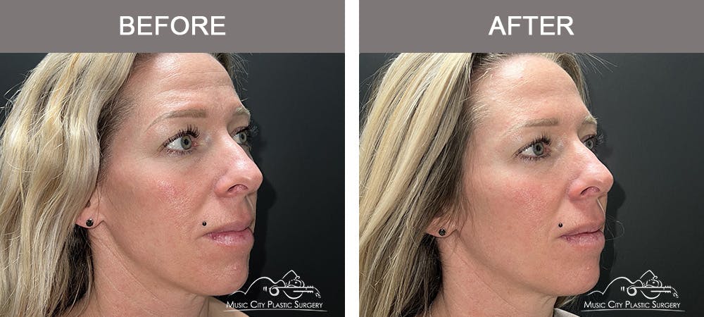 Dermal Fillers Before & After Gallery - Patient 179930 - Image 2