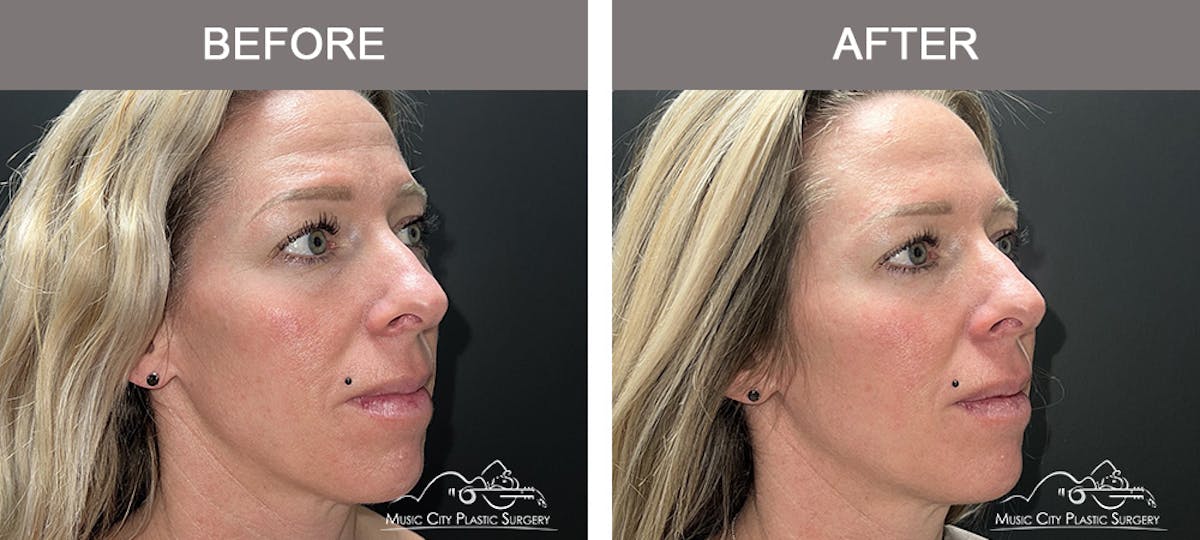Dermal Fillers Before & After Gallery - Patient 179930 - Image 2