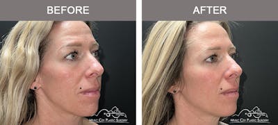 Dermal Fillers Before & After Gallery - Patient 179930 - Image 2