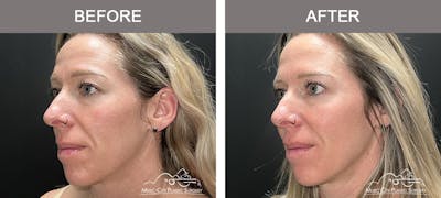 Dermal Fillers Before & After Gallery - Patient 179930 - Image 3