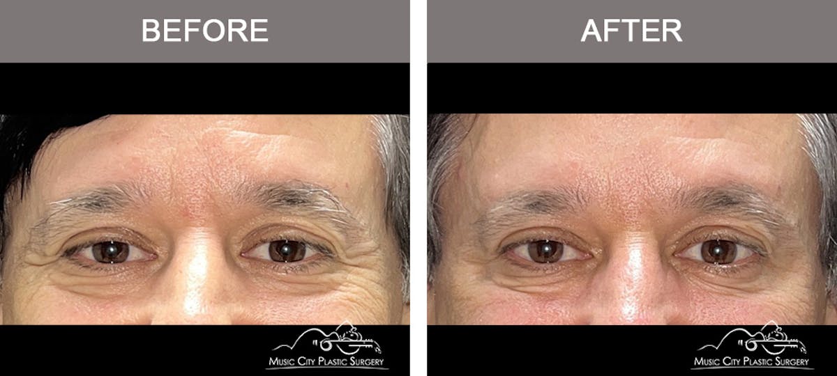 Dysport or Botox Before & After Gallery - Patient 294551 - Image 1