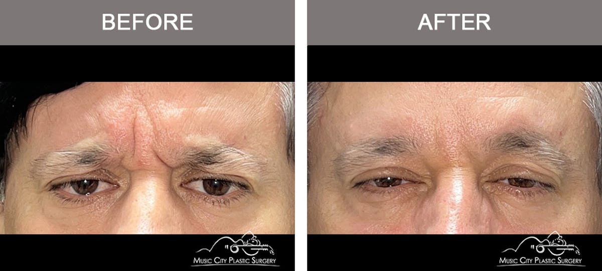 Dysport or Botox Before & After Gallery - Patient 294551 - Image 2