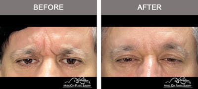 Dysport or Botox Before & After Gallery - Patient 294551 - Image 2