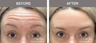 Dysport or Botox Before & After Gallery - Patient 182764 - Image 1