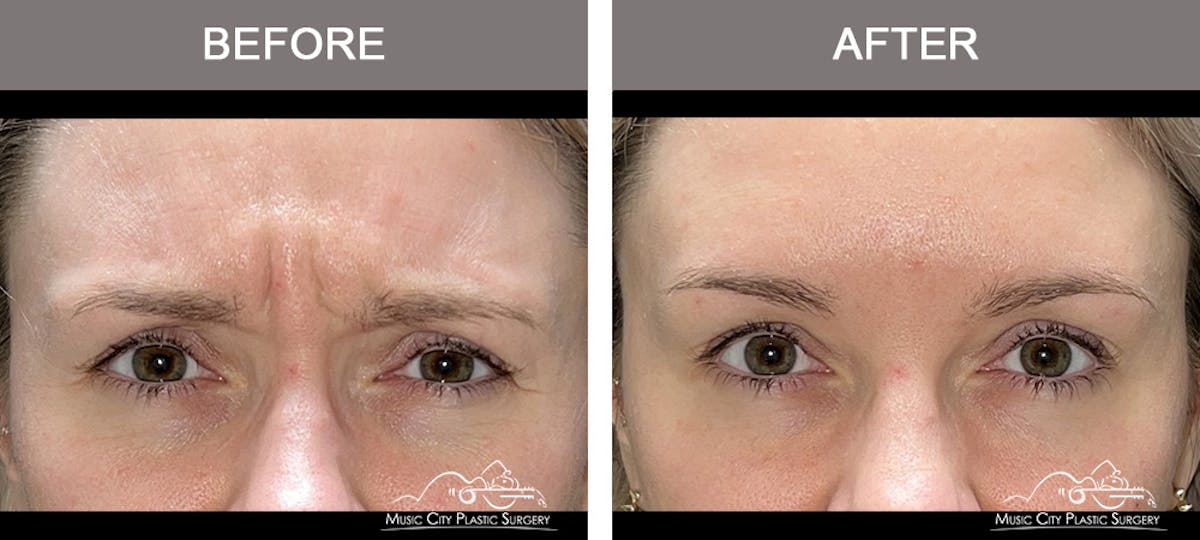 Dysport or Botox Before & After Gallery - Patient 182764 - Image 2