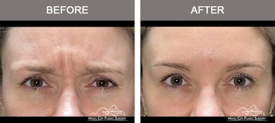 Dysport or Botox Before & After Gallery - Patient 182764 - Image 2