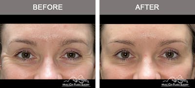 Dysport or Botox Before & After Gallery - Patient 182764 - Image 3