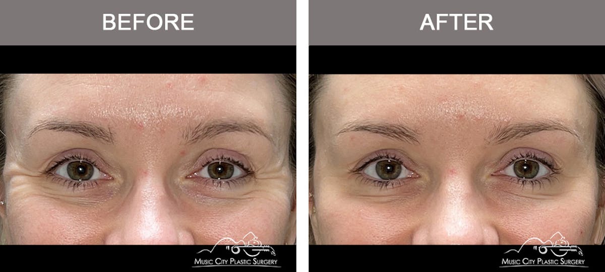 Dysport or Botox Before & After Gallery - Patient 182764 - Image 3