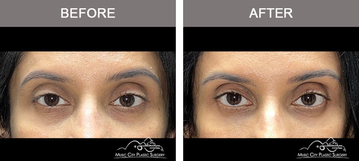 Dermal Fillers Before & After Gallery - Patient 182355 - Image 1