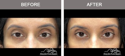 Dermal Fillers Before & After Gallery - Patient 182355 - Image 1