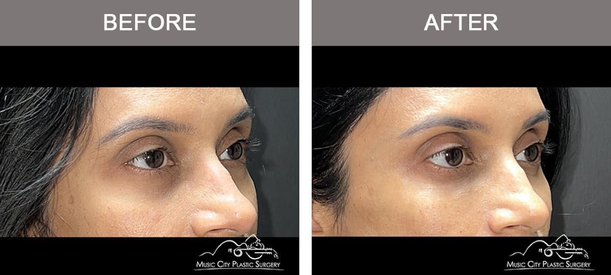 Dermal Fillers Before & After Gallery - Patient 182355 - Image 3