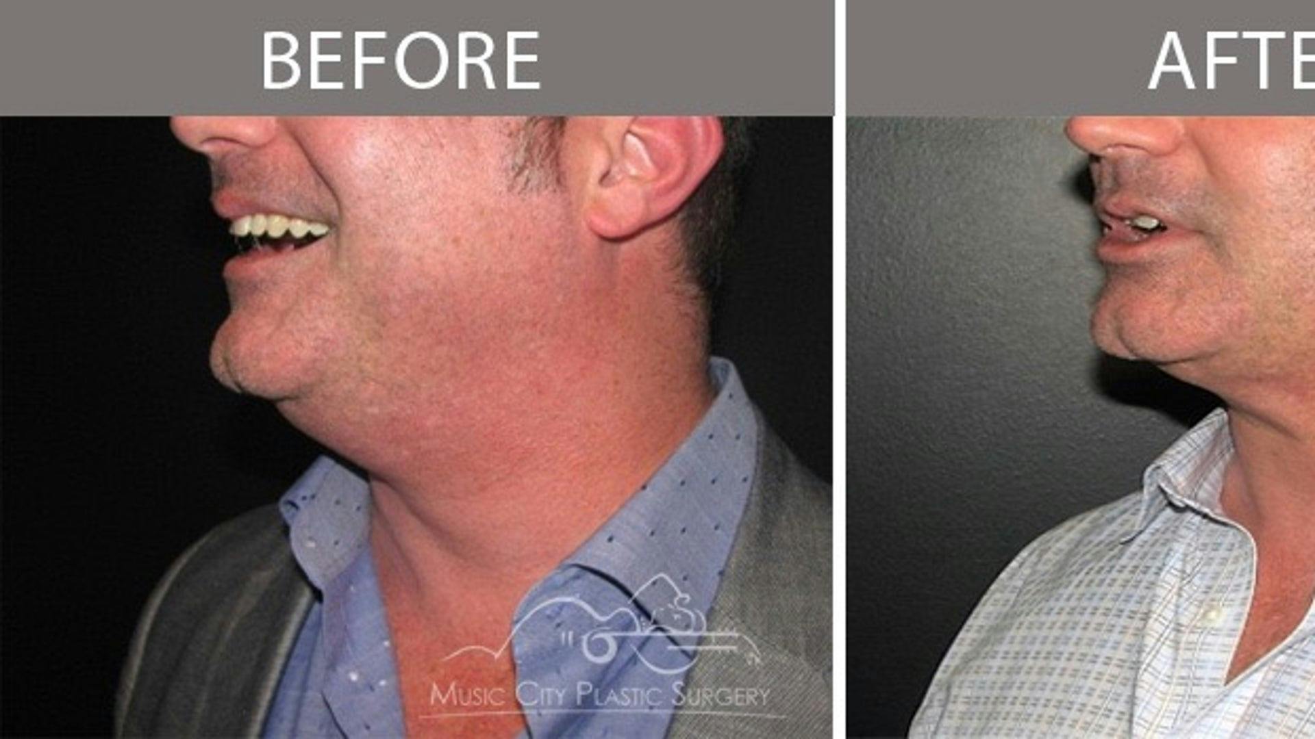 Doctors See Surge in Men Seeking Surgery-free Double Chin Solution