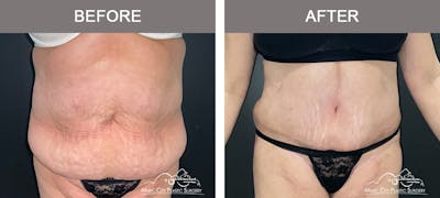 Liposuction Before & After Gallery - Patient 413858 - Image 1