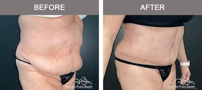 Liposuction Before & After Gallery - Patient 413858 - Image 2