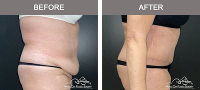 Abdominoplasty Before & After Gallery - Patient 144056 - Image 3