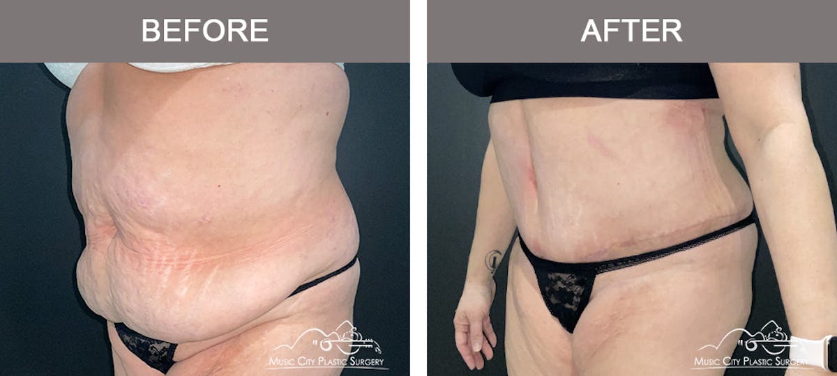 Liposuction Before & After Gallery - Patient 413858 - Image 4