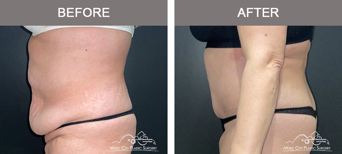 Abdominoplasty Before & After Gallery - Patient 144056 - Image 5