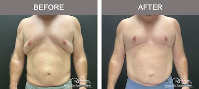 Gynecomastia Before & After Gallery - Patient 224592 - Image 1