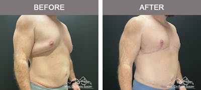 Body Lift Before & After Gallery - Patient 258505 - Image 2