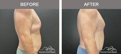 Gynecomastia Before & After Gallery - Patient 224592 - Image 3