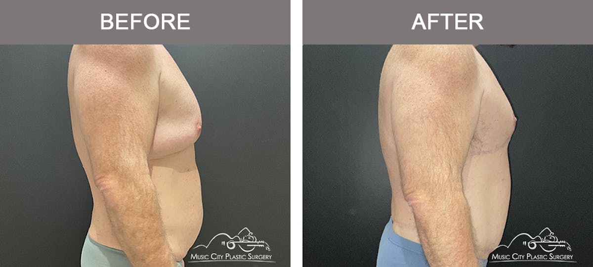 Gynecomastia Before & After Gallery - Patient 224592 - Image 3