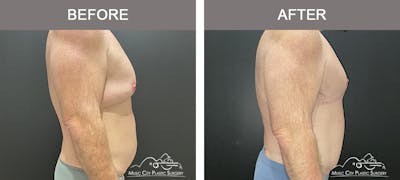 Body Lift Before & After Gallery - Patient 258505 - Image 3