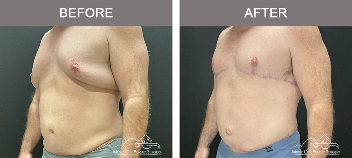 Gynecomastia Before & After Gallery - Patient 224592 - Image 4