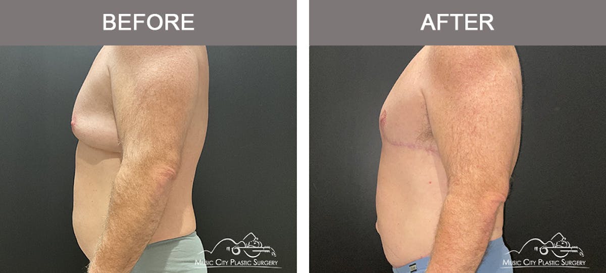 Body Lift Before & After Gallery - Patient 258505 - Image 5
