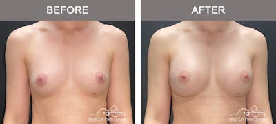 Breast Augmentation Before & After Gallery - Patient 185854 - Image 1