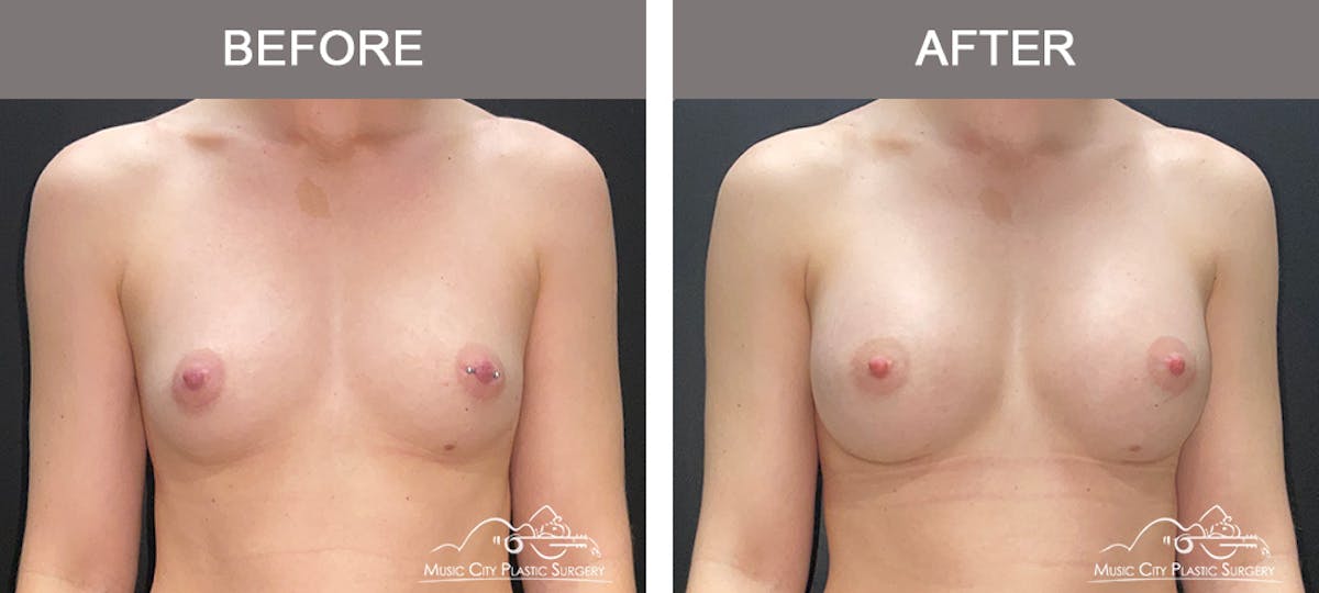 Breast Augmentation Before & After Gallery - Patient 185854 - Image 1