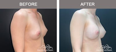 Breast Augmentation Before & After Gallery - Patient 185854 - Image 2